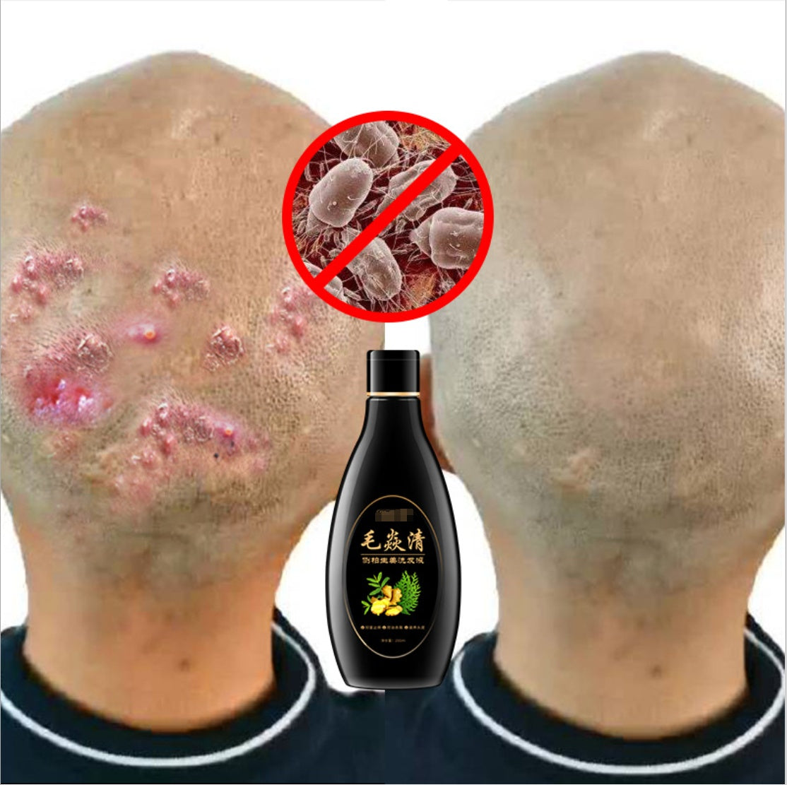 Scalp Hair Follicle Shampoo Antibacterial Itching Mites And Oil Control