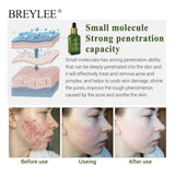 BREYLEE Acne Treatment Serum Face Facial Anti Acne Scar Removal Cream Skin Care Whitening Repair Pimple Remover For Acne